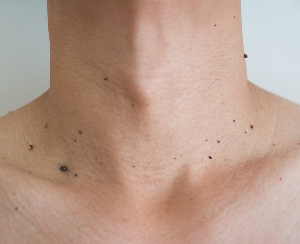 Dermatolojik Tedaviler ben et beni tedavisi İstanbul Bahçeşehir Başakşehir