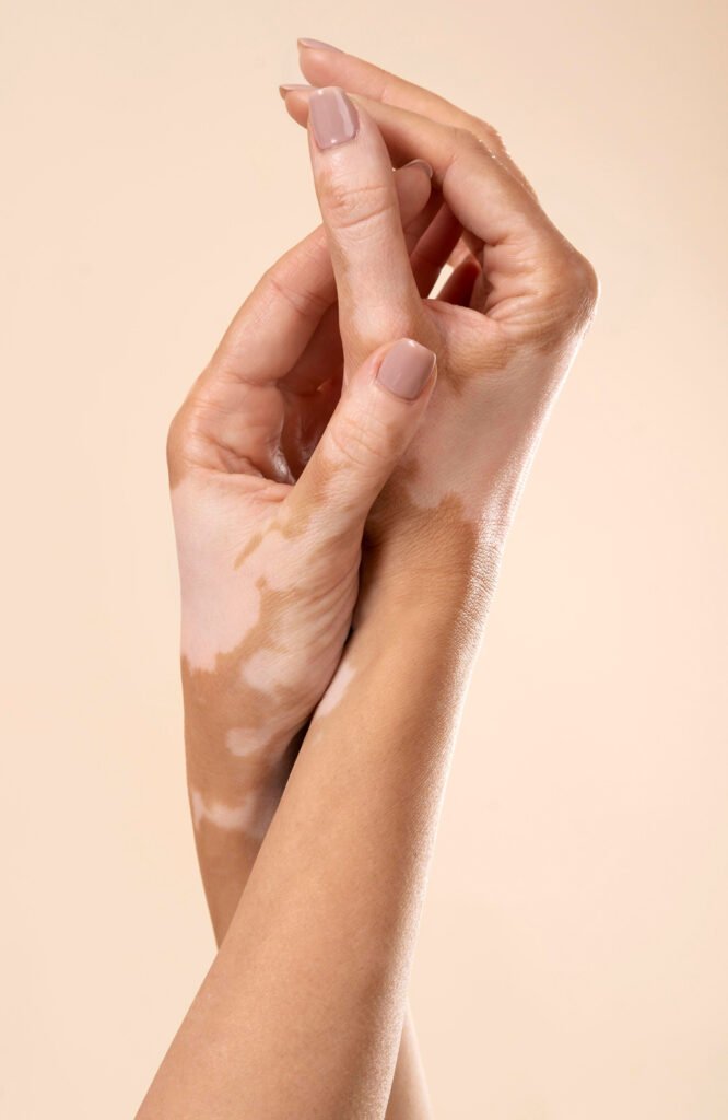 Vitiligo Tedavisi İstanbul Bahçeşehir Başakşehir